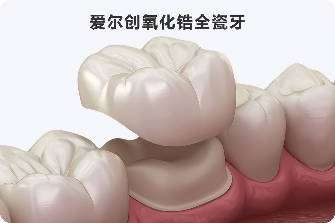 爱尔创氧化锆全瓷牙多少钱一颗(图1)